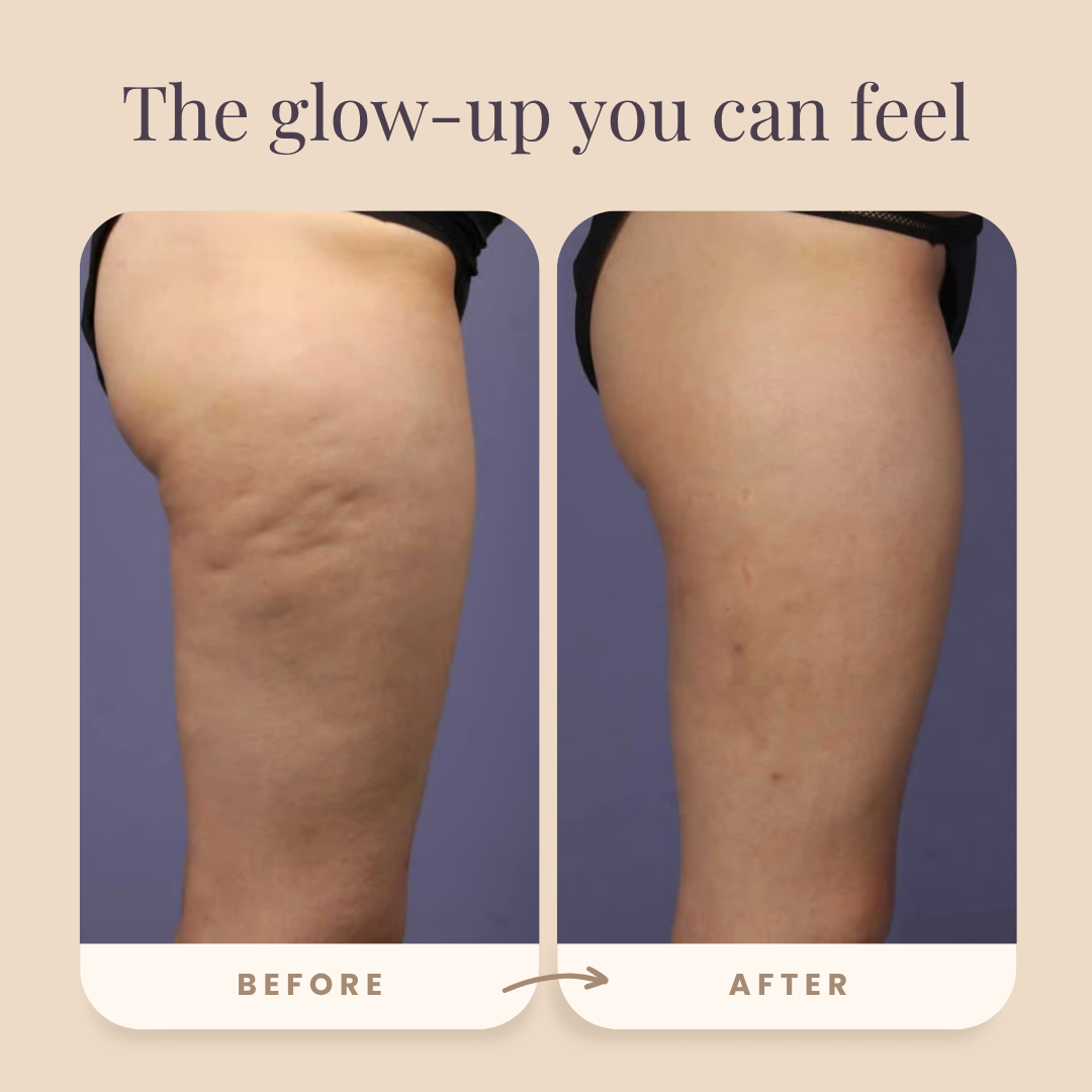 Acurea Sculpt