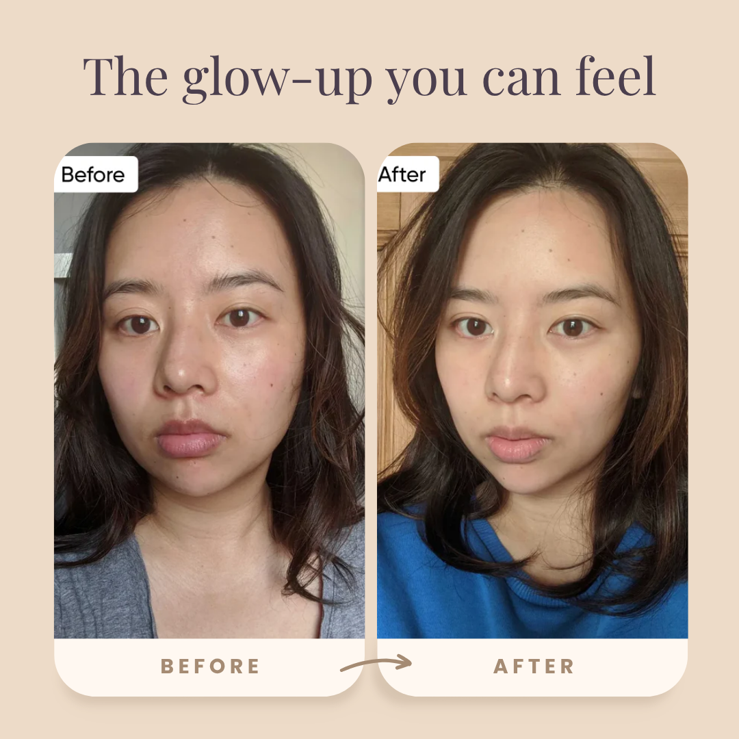 Acurea LumoLift
